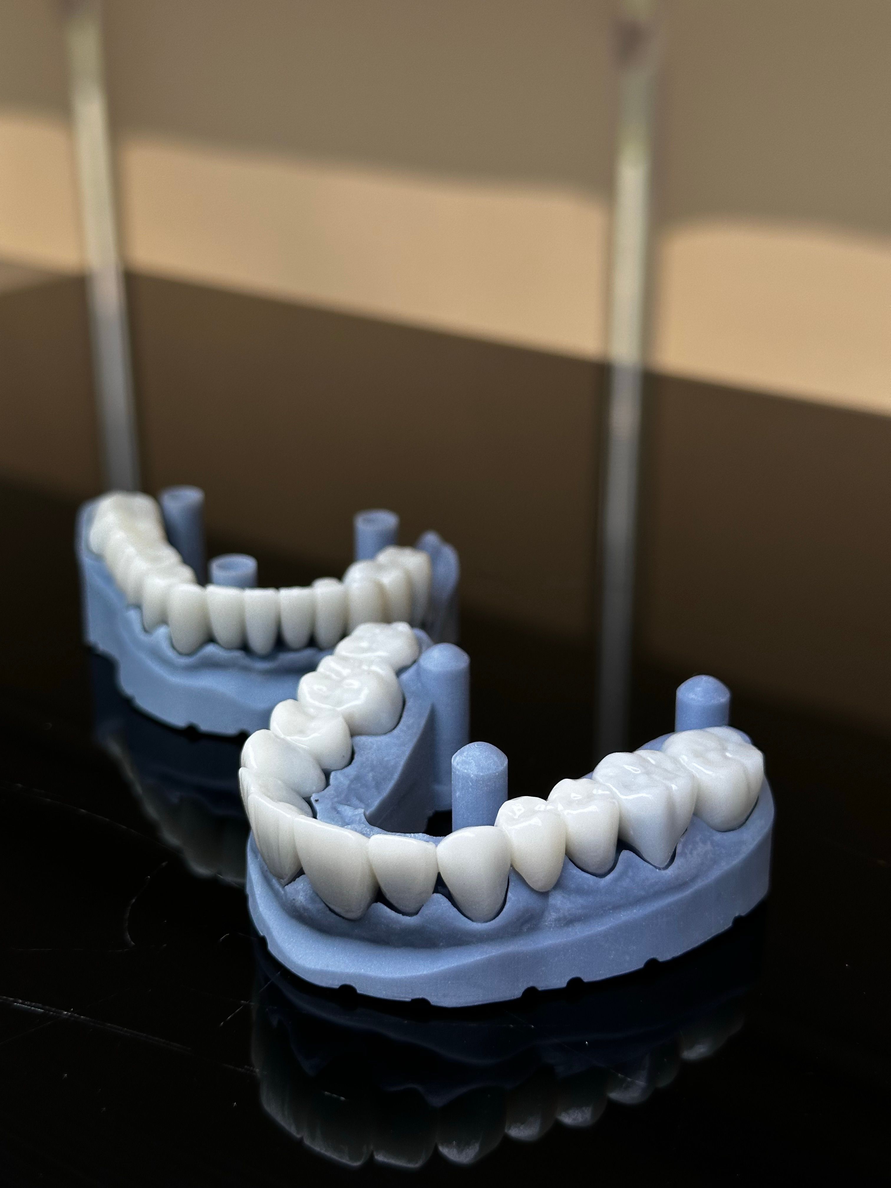 Coronas de Zirconia